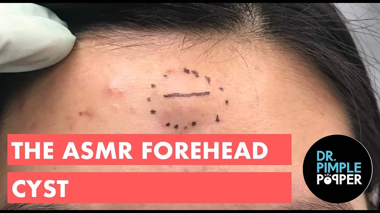 The ASMR Forehead Cyst