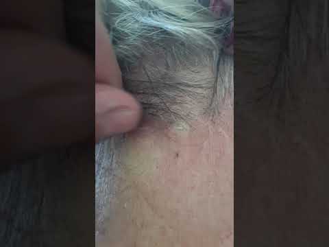 The beggining of pimple popping