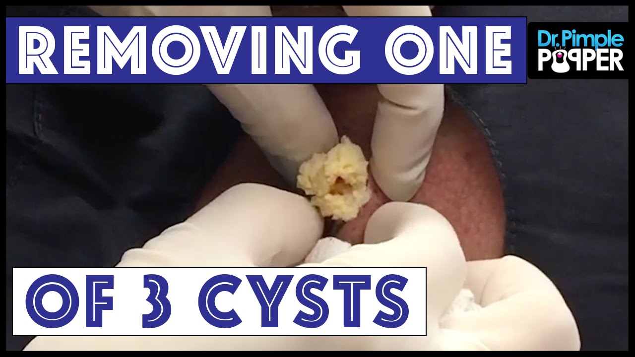 The Bermuda Triangle: Cyst excision #1