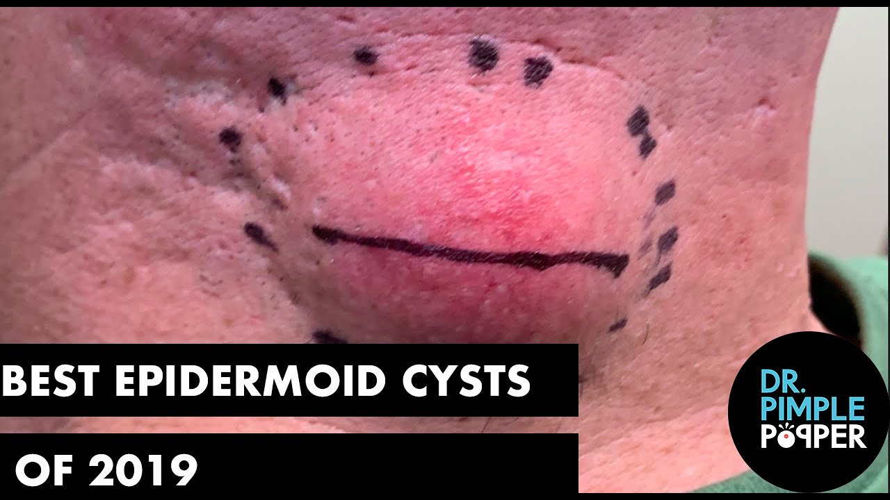 The Best Epidermoid Cyst of 2019