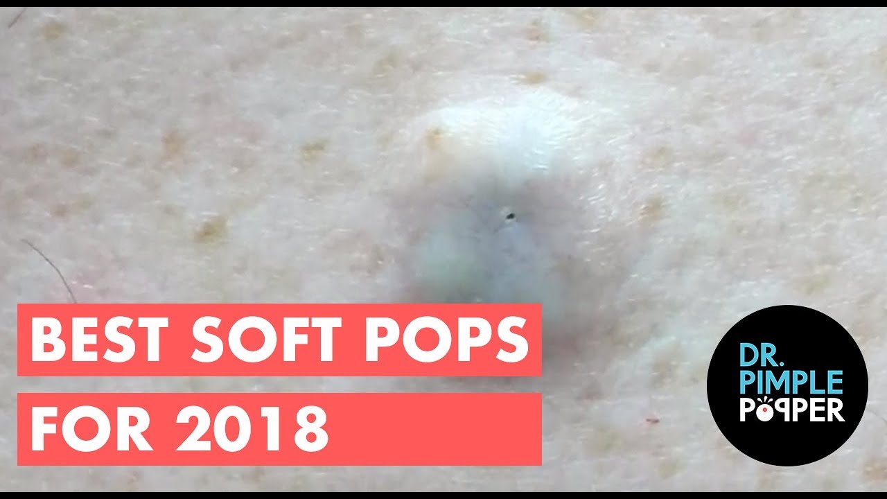 The BEST OF Softpops 2015 for 2018! Dr Pimple Popper