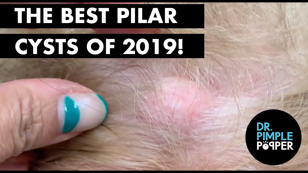 The Best Pilar Cysts of 2019!