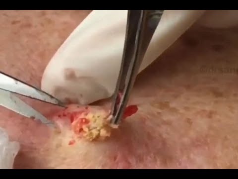 The best Pimple Popping Videos 2017