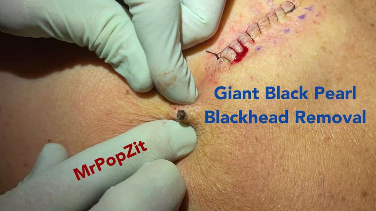 The Black Pearl Giant Blackhead removal. Large cyst above it coming soon! Big squeeze extraction!