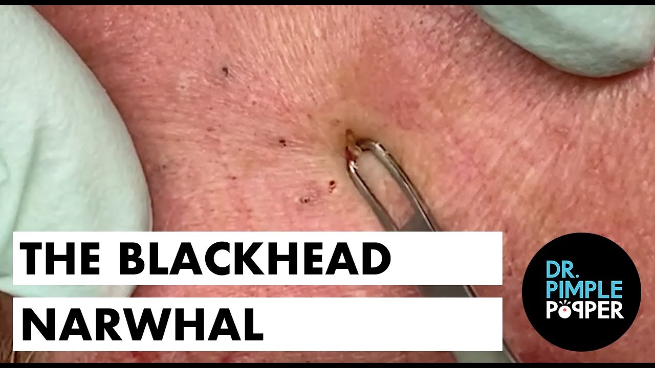 The Blackhead Narwhal