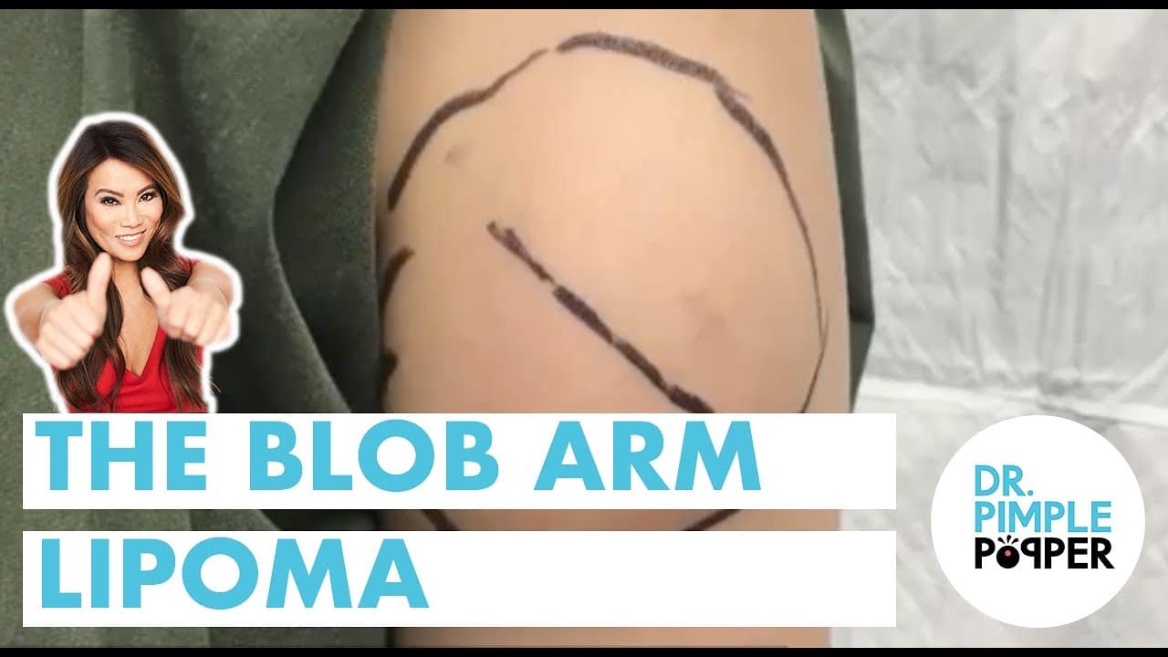 The Blob Arm Lipoma