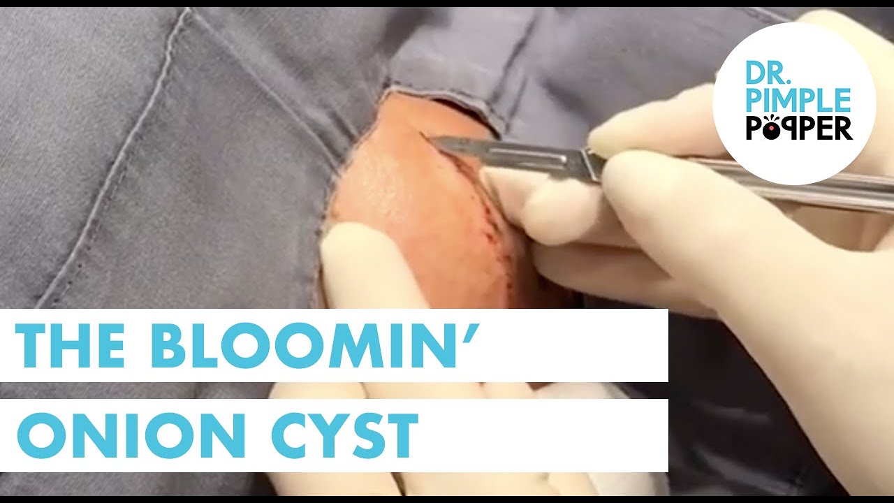 The Bloomin’ Onion Cyst