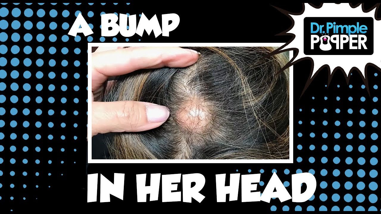 The Bump in Her Head…