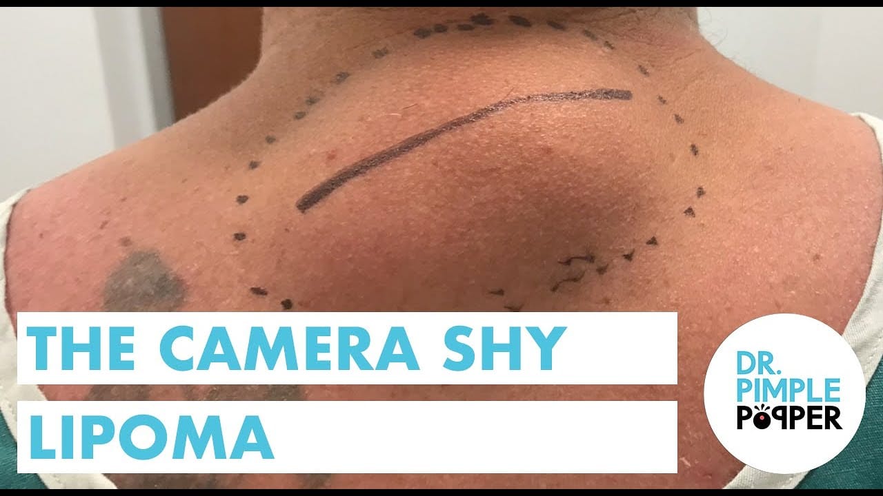 The Camera Shy Lipoma