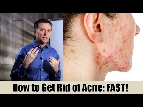 The Causes of Acne – How To Get Rid Fast – Dr.Berg