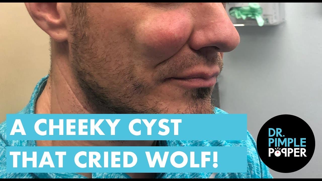 The Cheek Cyst That Cried Wolf