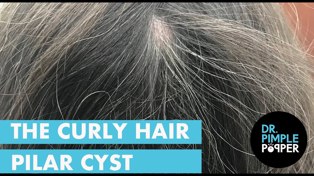 The Curly Hair Pilar Cyst