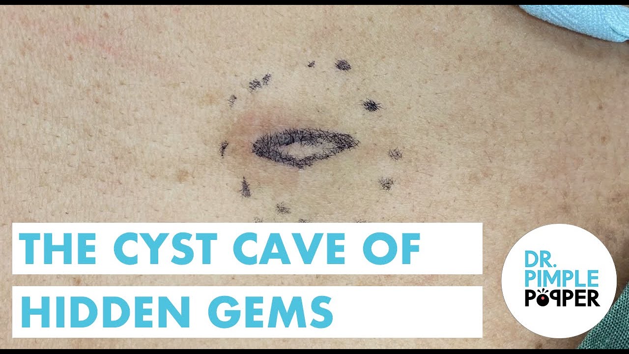The Cyst Cave of Hidden Gems