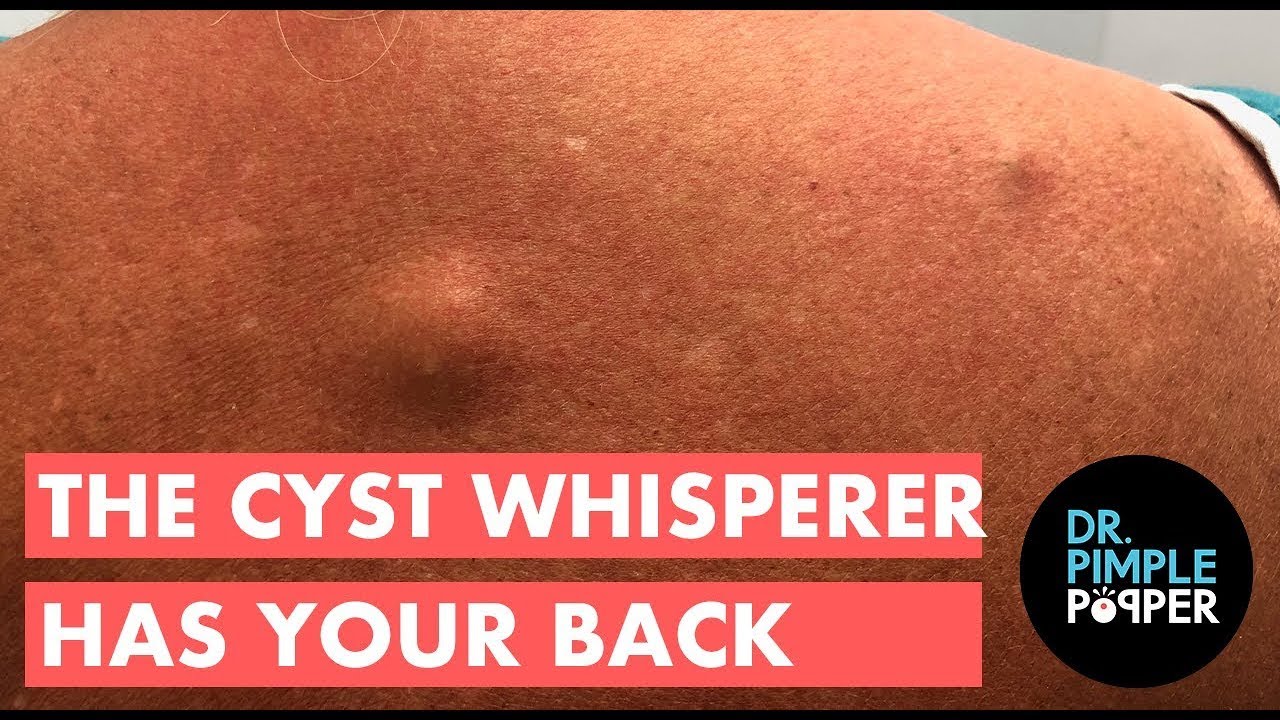 The Cyst Whisperer Has Your Back