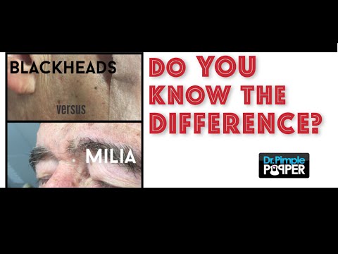 The difference between blackheads & milia
