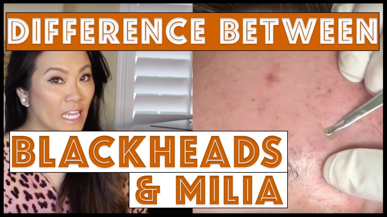 The difference between blackheads and milia with INTRO