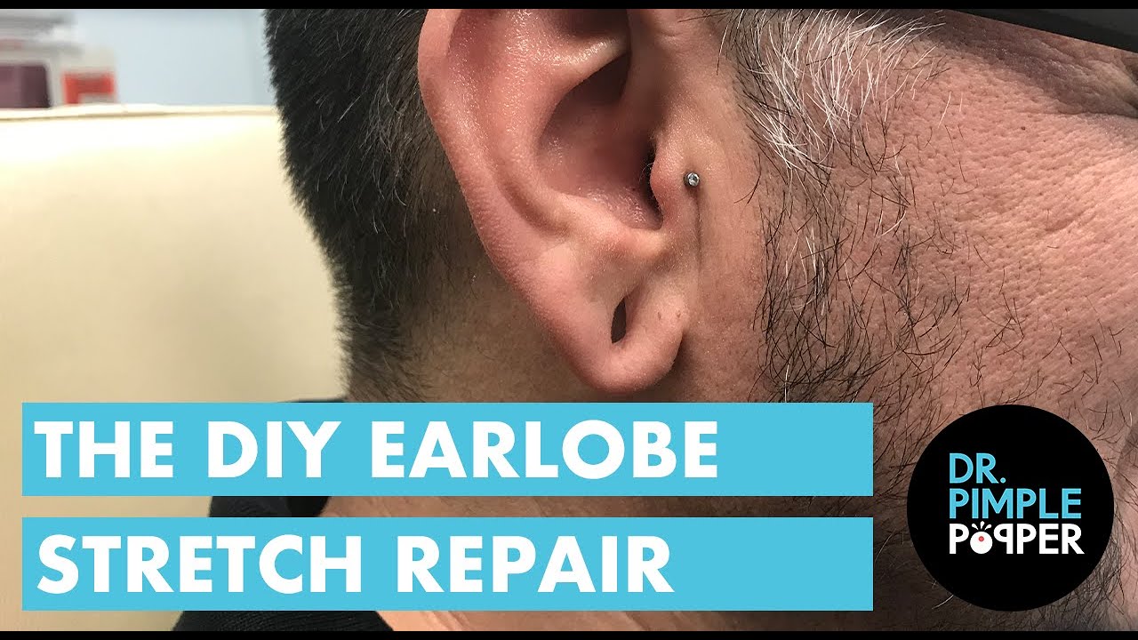 The DIY Earlobe Stretch Repair