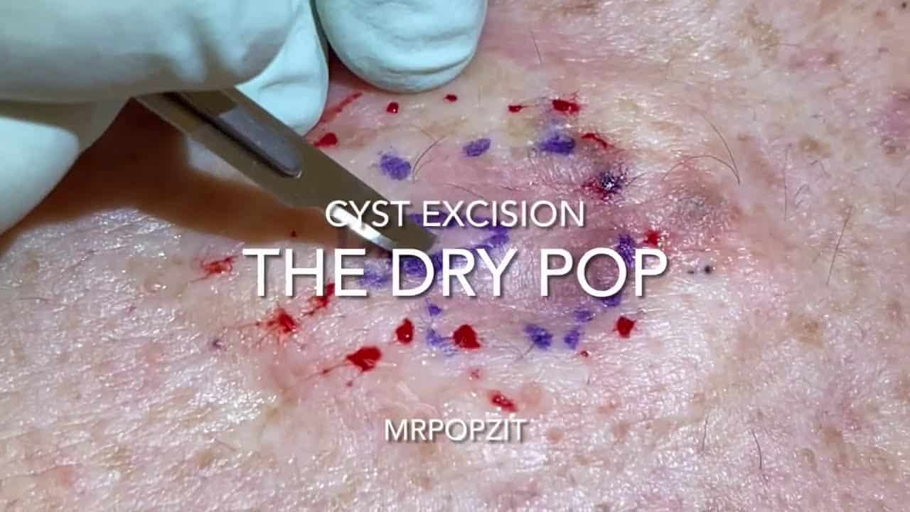 The dry pop cyst pop. Very dry old cyst on back with surrounding blackheads. Big squeeze removal.