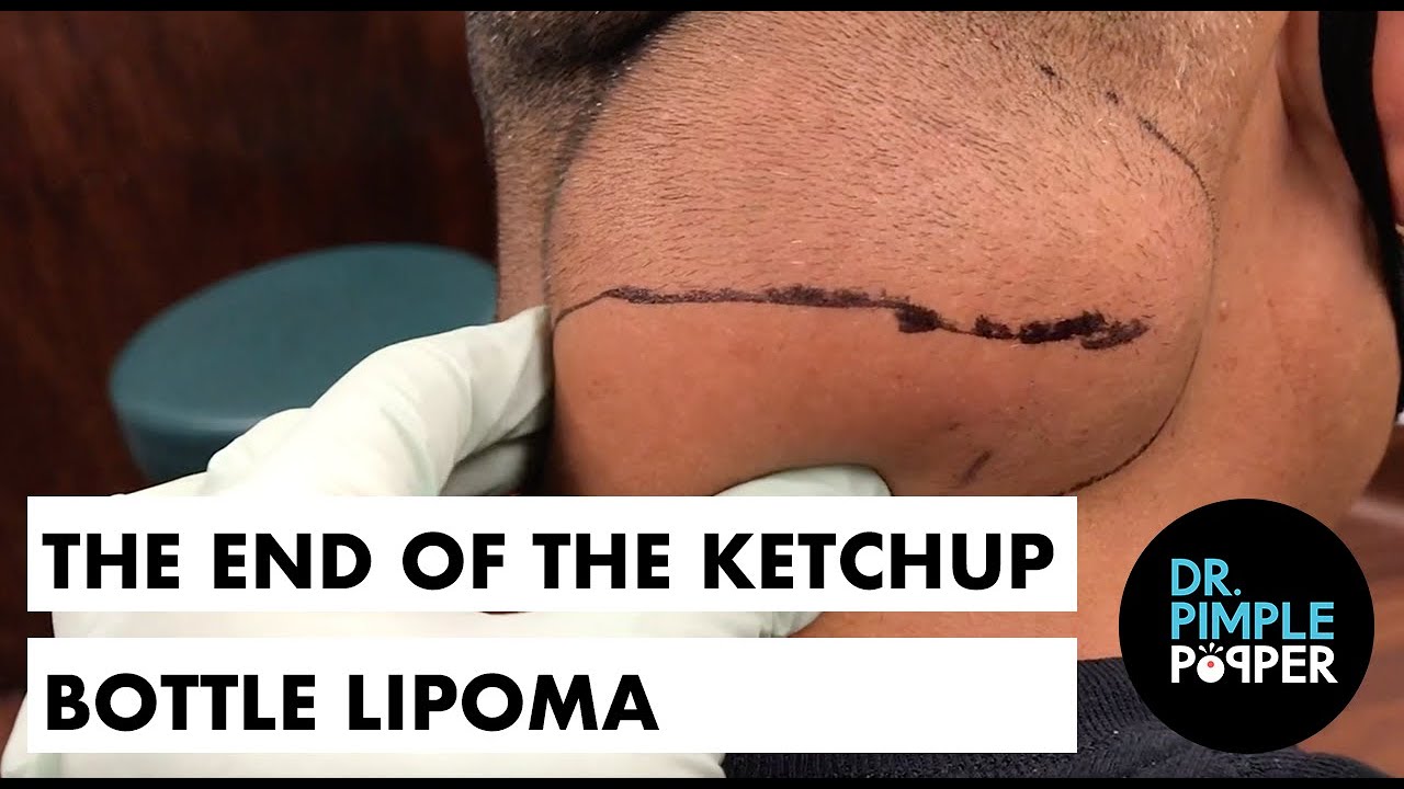 The End of the Ketchup Bottle Lipoma