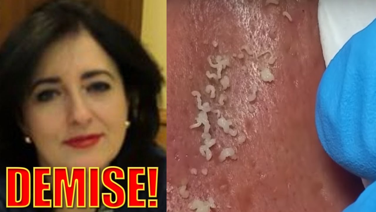 The Fall of Pimple Popping!  YouTube's Pimple Popping Decline