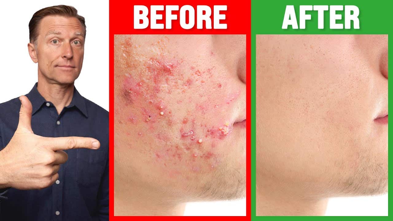 The FASTEST Way to Rid Acne – Dr. Berg