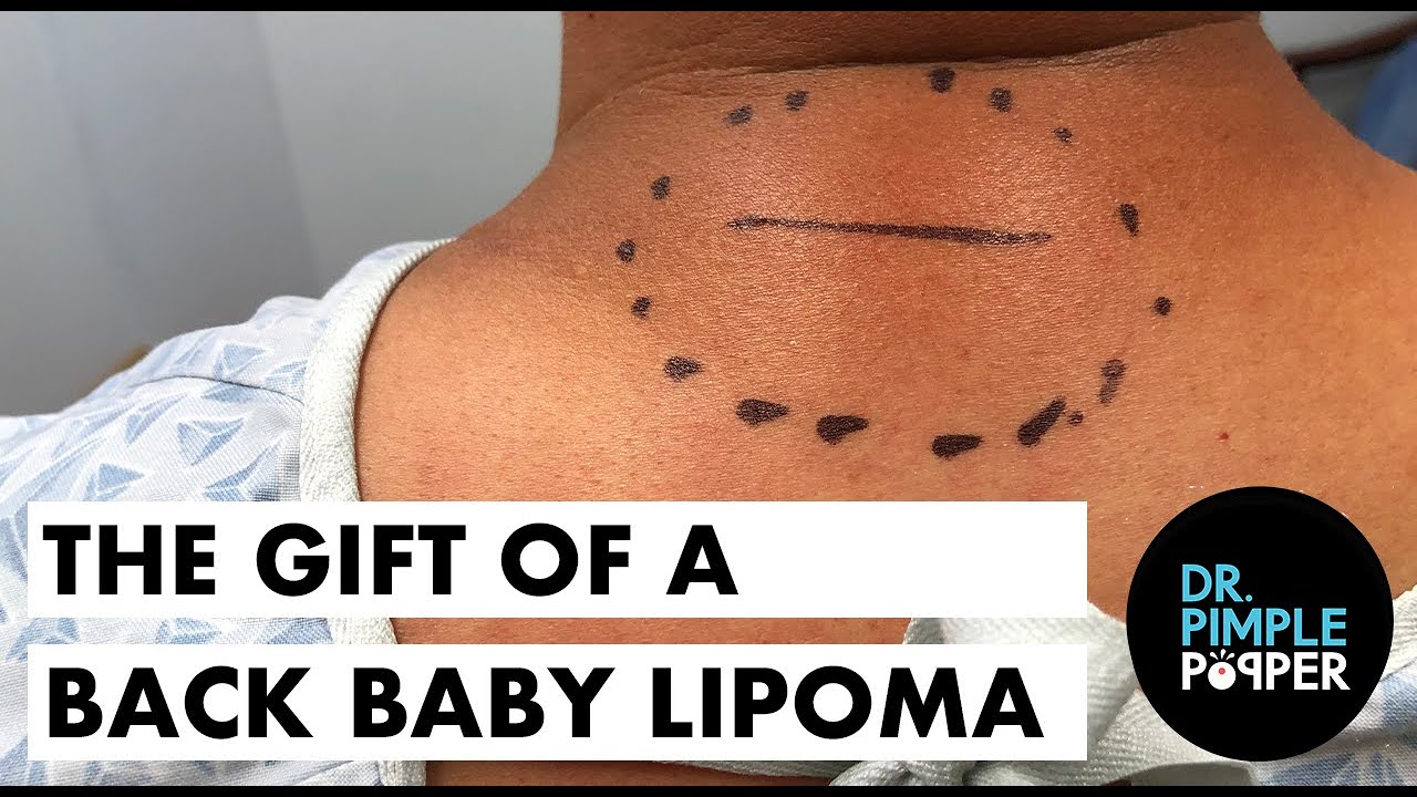 The Gift of A Back Baby Lipoma