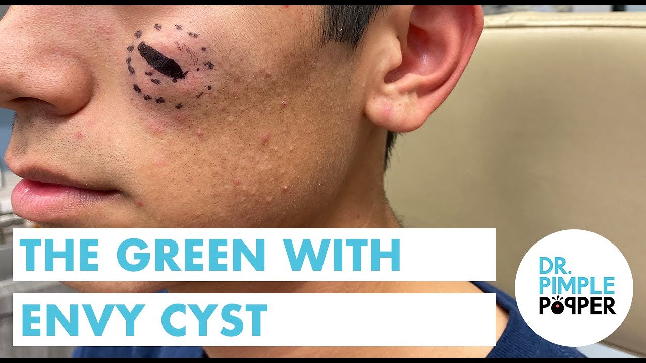 The Green with Envy Epidermoid Cyst