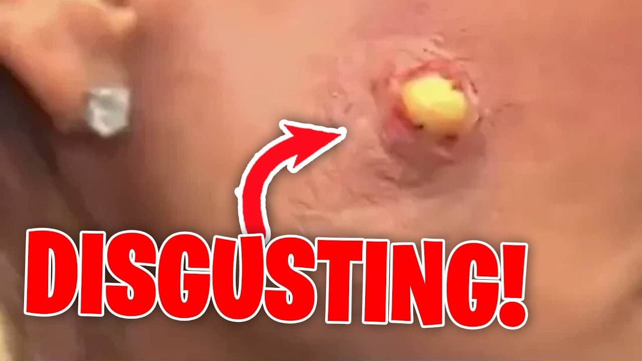 The GROSSEST and MOST DISGUSTING moments on Dr. Pimple Popper (Part 4)
