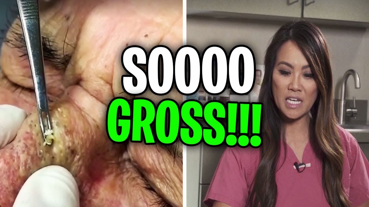 The GROSSEST and Most DISGUSTING Moments from Dr. Pimple Popper! (Part 19)
