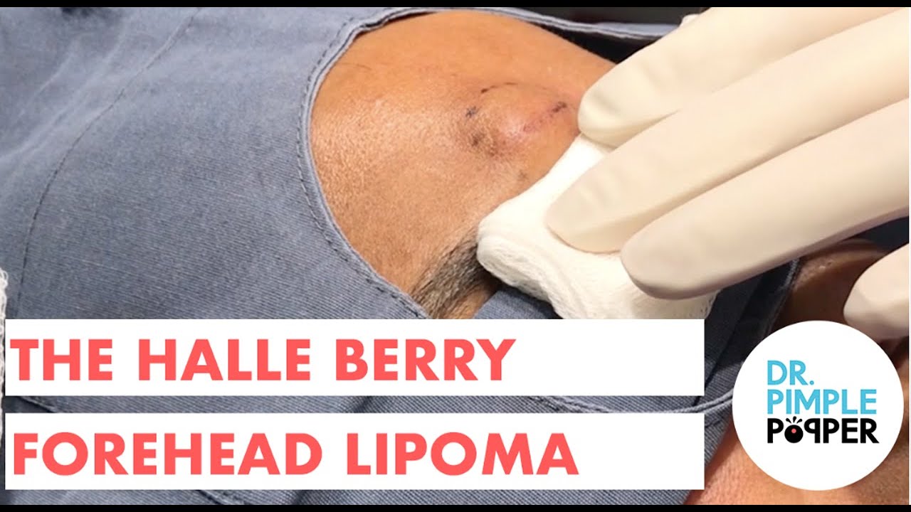 The Halle Berry Forehead Lipoma – OFFICE POP FLOPS