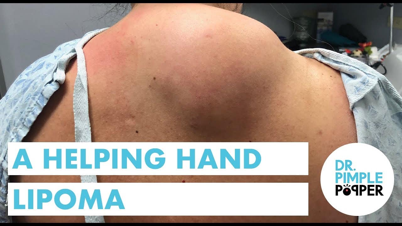 The Helping Hand Lipoma