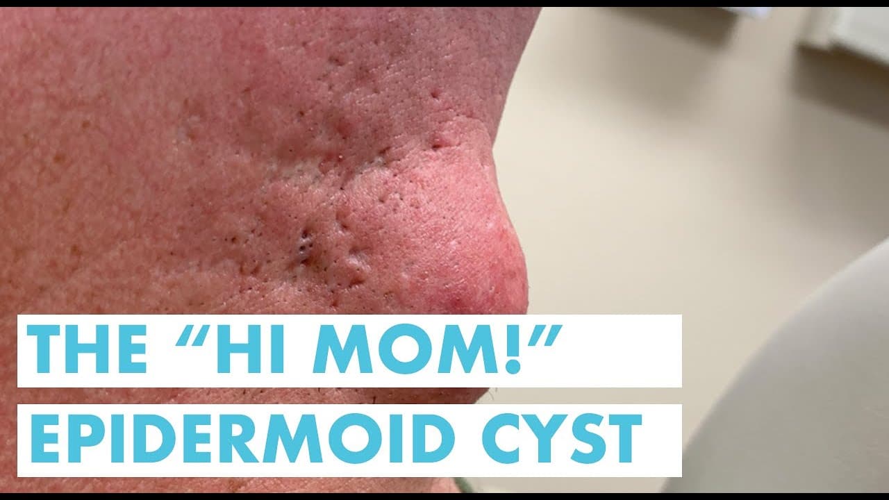 The “Hi Mom!” Epidermoid Cyst