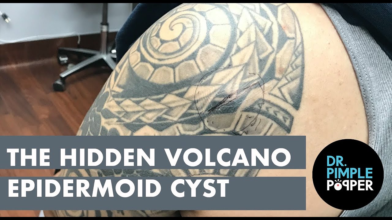 The Hidden Volcano Cyst