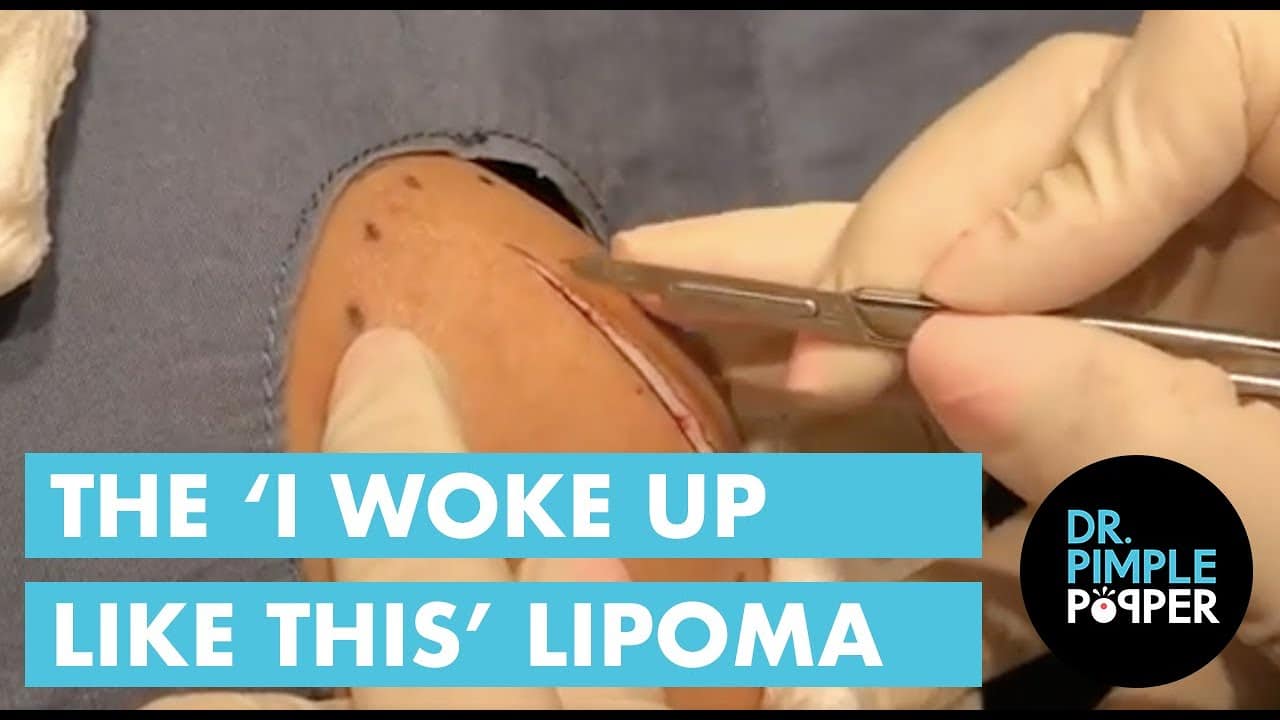 The ‘I Woke Up Like This’ Lipoma