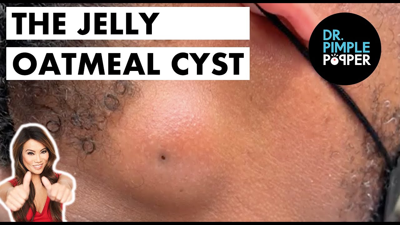 The Jelly Oatmeal Cyst