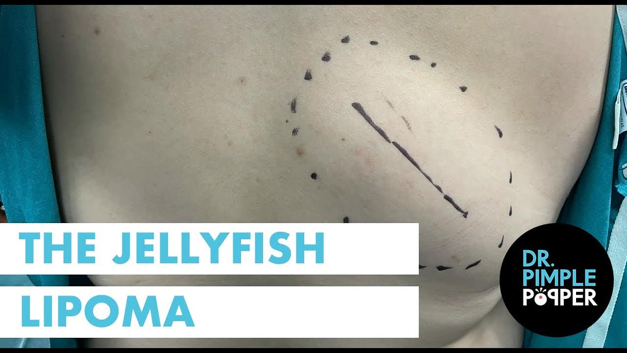 The Jellyfish Lipoma