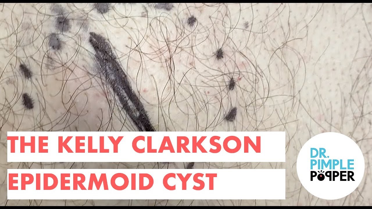 The Kelly Clarkson Epidermoid Cyst