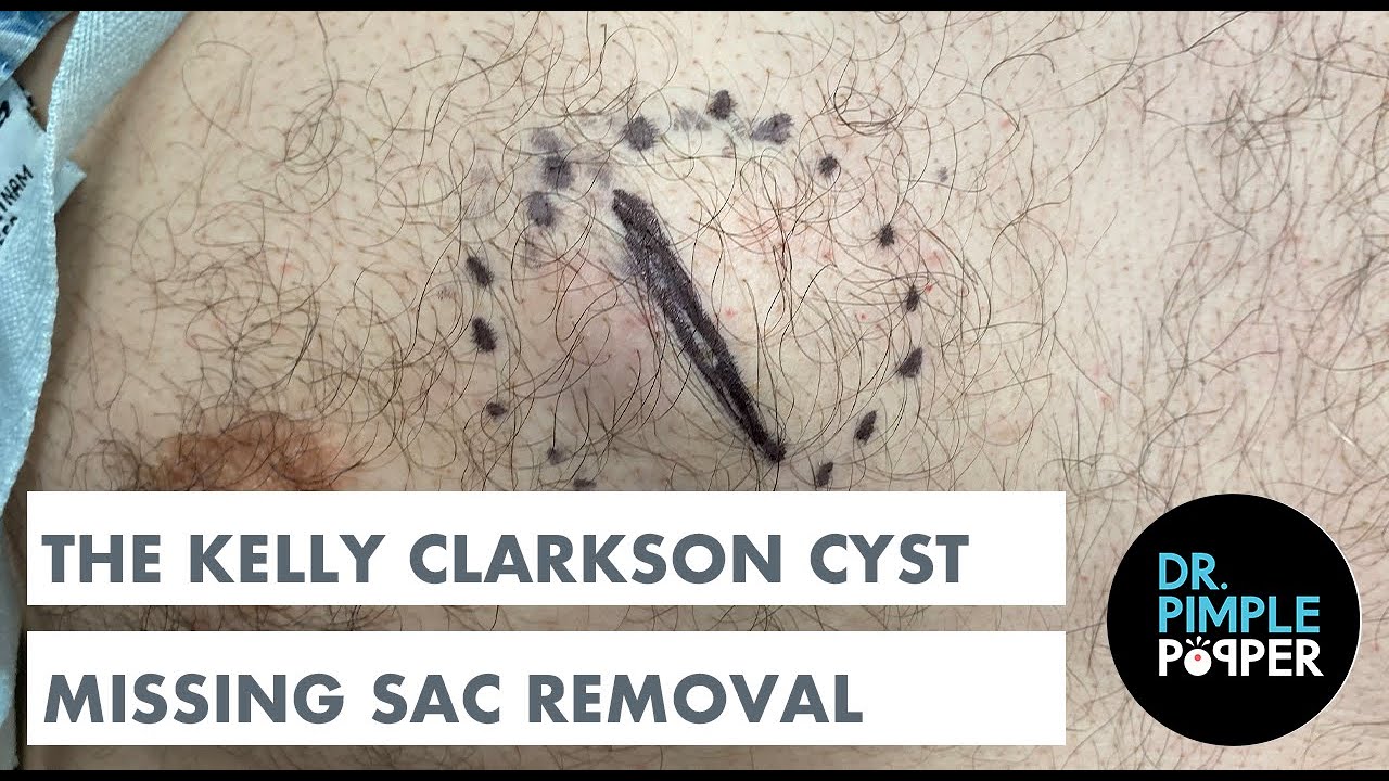 The Kelly Clarkson Epidermoid Cyst: WITH MISSING SAC WALL REMOVAL