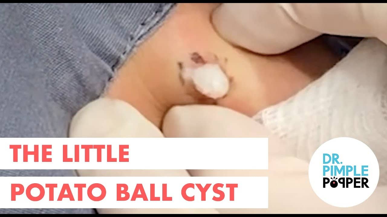 The Little Potato Ball Cyst