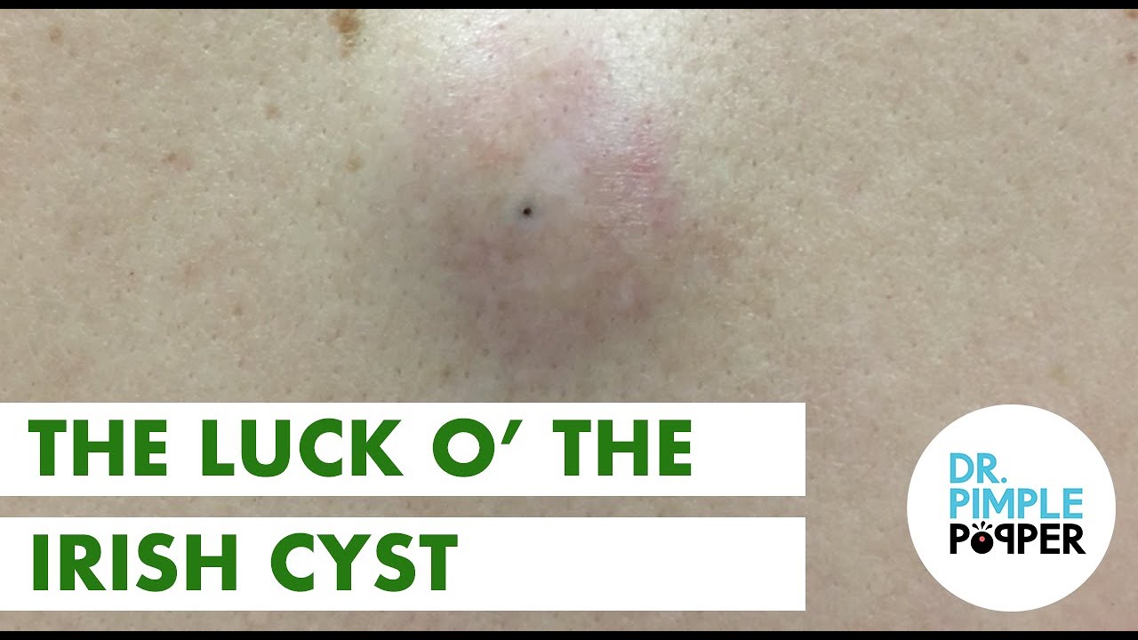 The Luck O’ The Irish Cyst