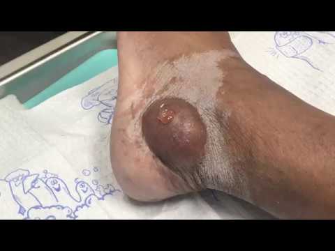 The Mac Daddy of Ganglion Cyst Pops