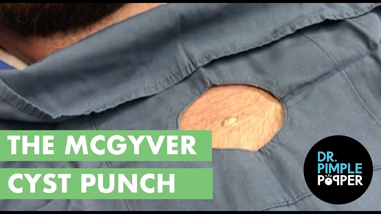 The MacGyver Cyst Punch