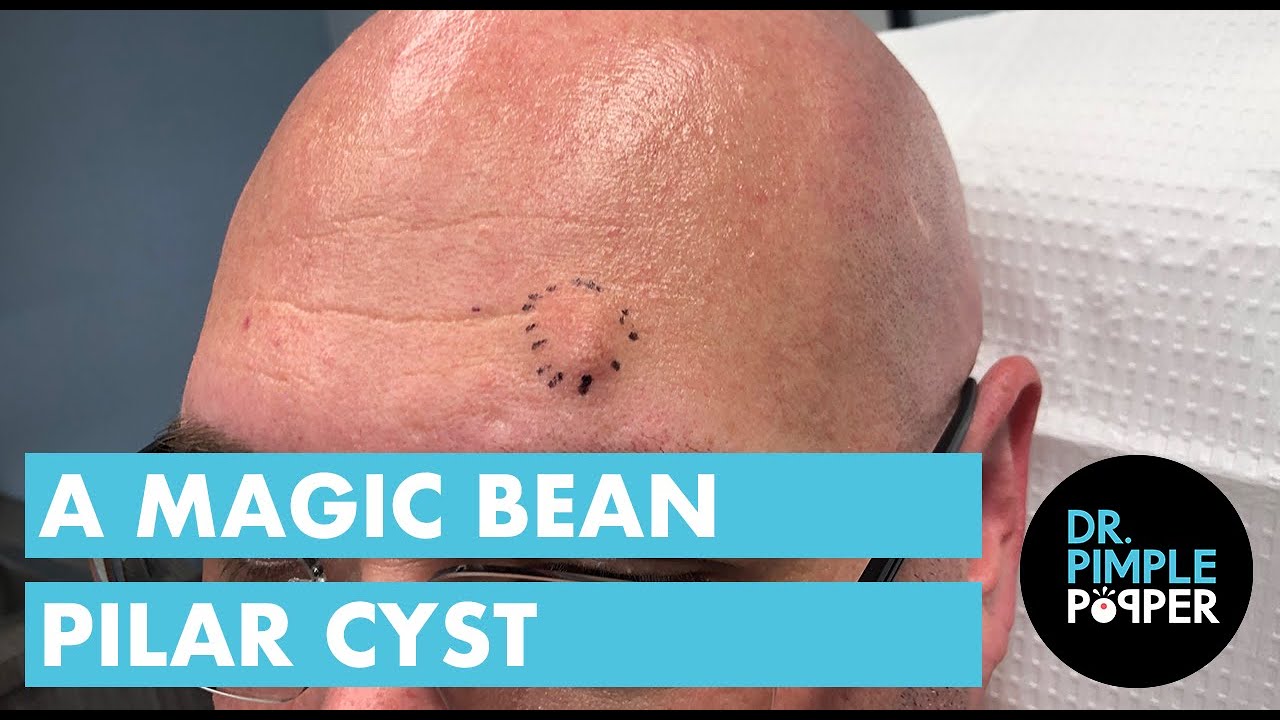 The Magic Bean Pilar Cyst