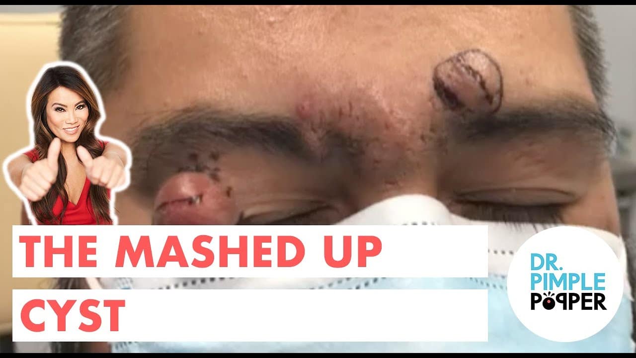 The Mashed Up Cyst