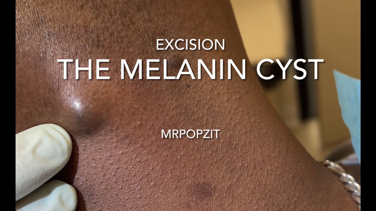 The Melanin Cyst. I answer common question about skin tone and cyst contents. Cyst pop. MrPopZit