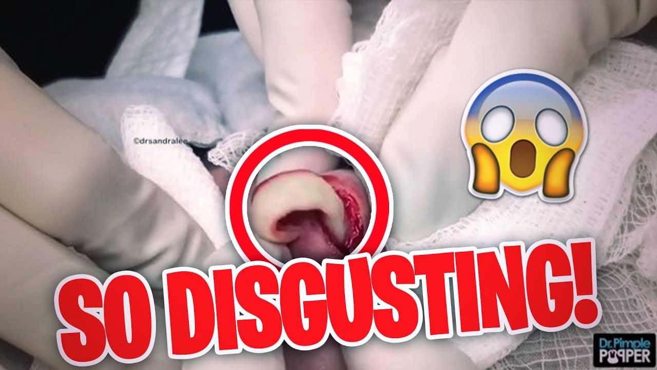The MOST DISGUSTING Pimple Popping Moments of 2020 (PART 3)