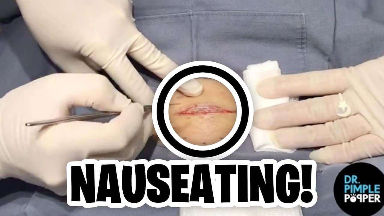 The Most NAUSEATING MOMENTS on Dr. Pimple Popper! Part 16