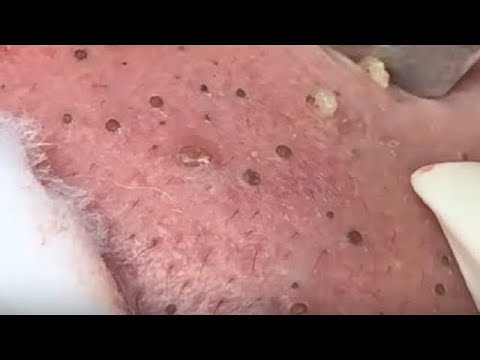 The Most Satisfing Skin Care ASMR #acne #blackheads#whiteheads, #Treatments #pimple# Part 07