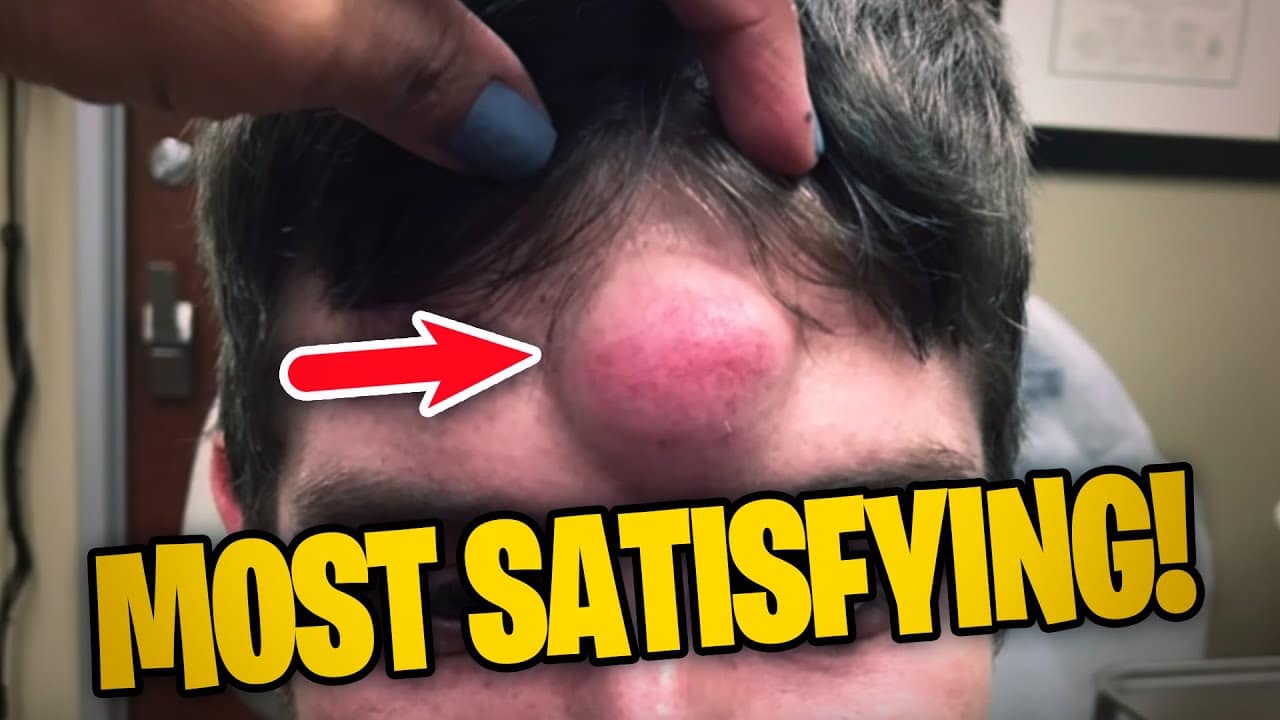 The Most satisfying Dr. Pimple Popping moments 2020 (PART 4)