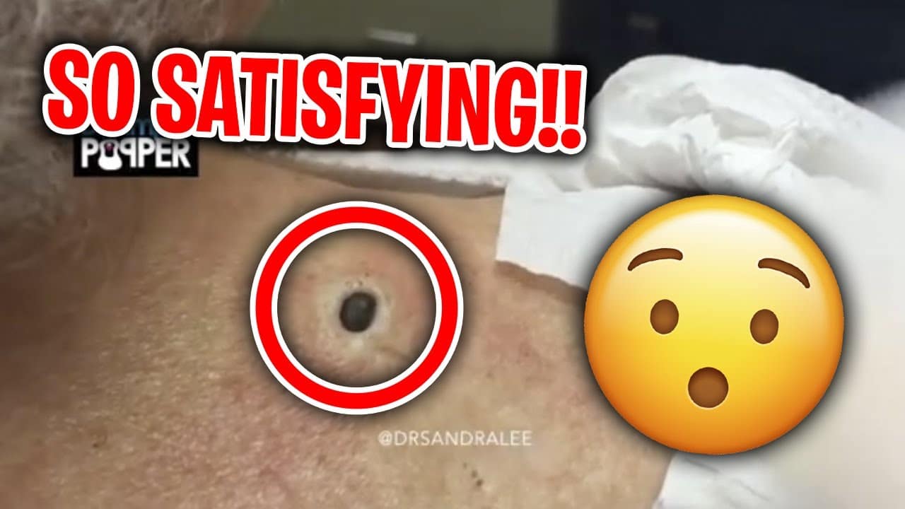 The Most satisfying Pimple Popping Moments of 2020 (PART 2)